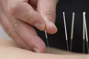 acupunctuur zoetermeer en utrecht wat is acupunctuur?
