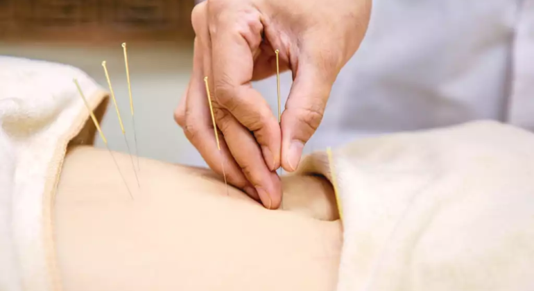acupunctuur therapie chinese acupunctuur, acupuncture